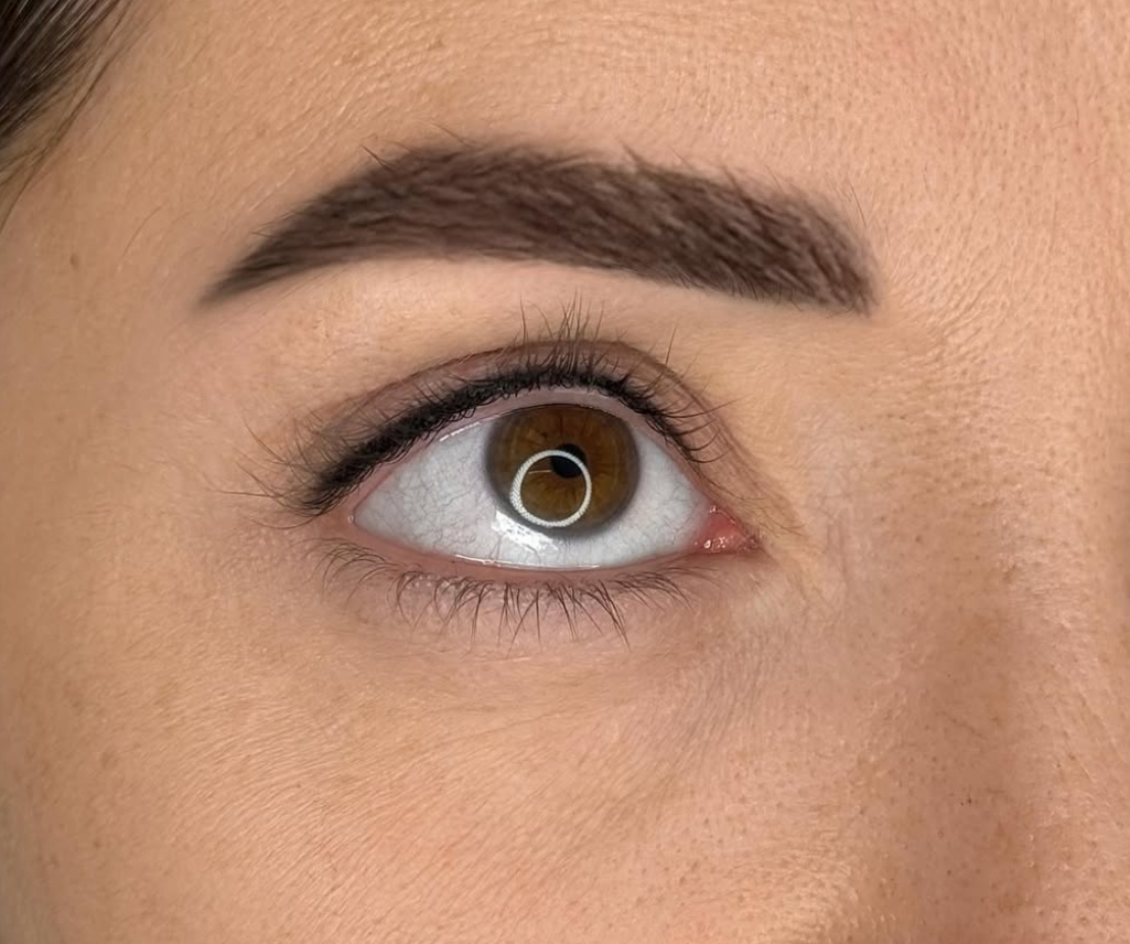 Wimpernkranzverdichtung